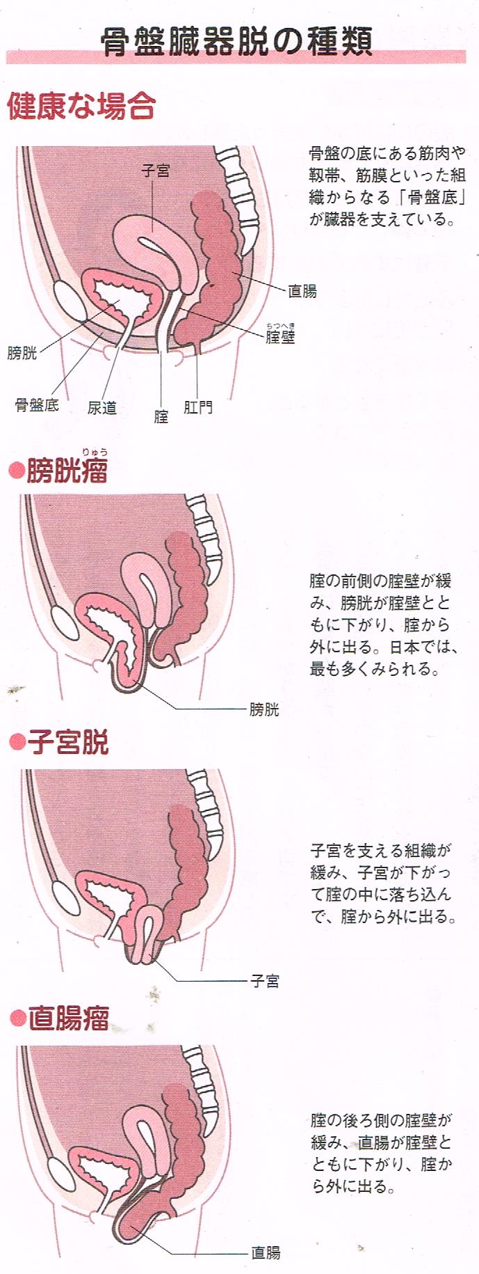 骨盤臓器脱の種類