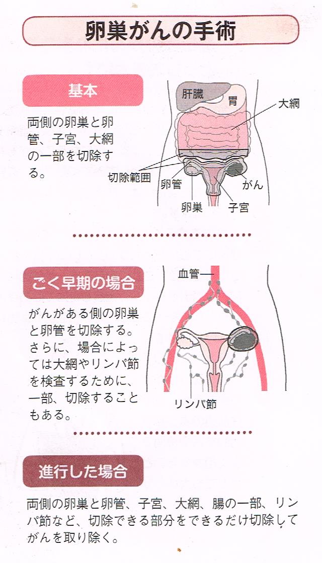 卵巣癌の手術