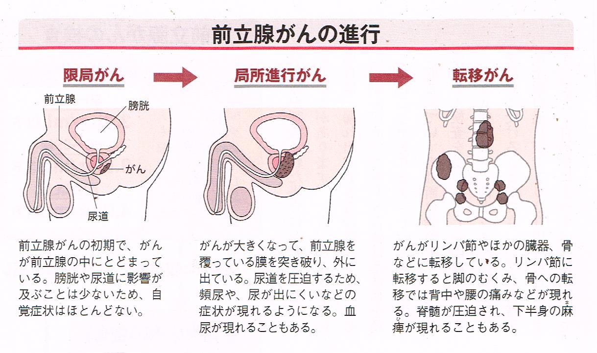 前立腺癌の進行