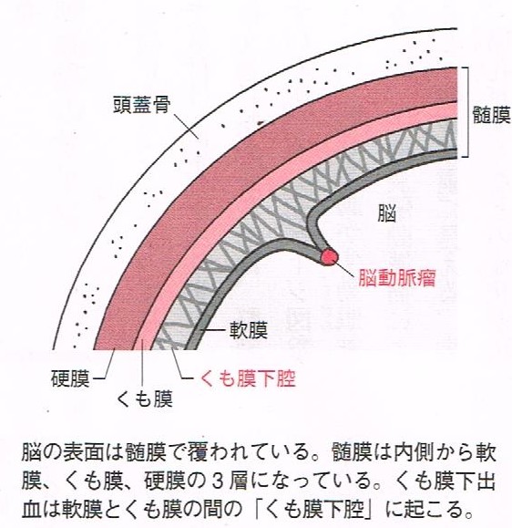 くも膜下出血の原因