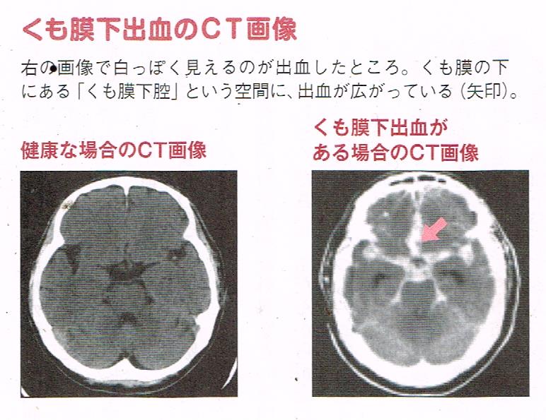 くも膜下出血の原因