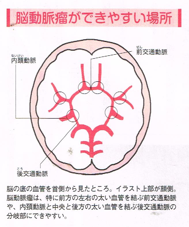 脳動脈瘤のできやすい場所