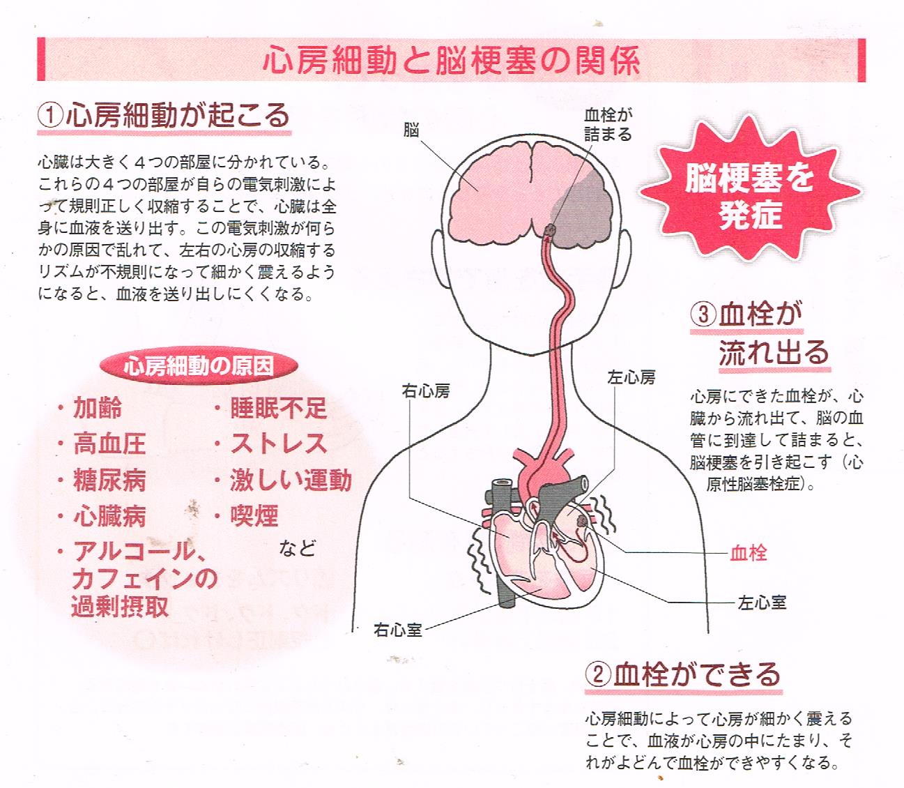 心房細動の原因