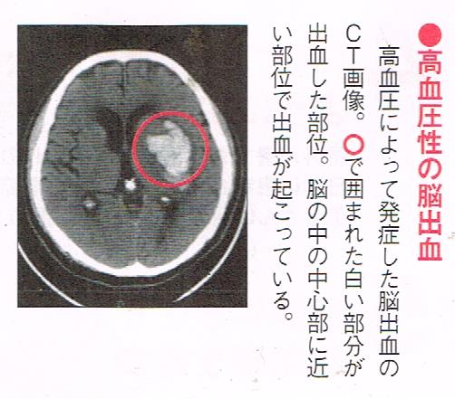 高血圧性の脳出血