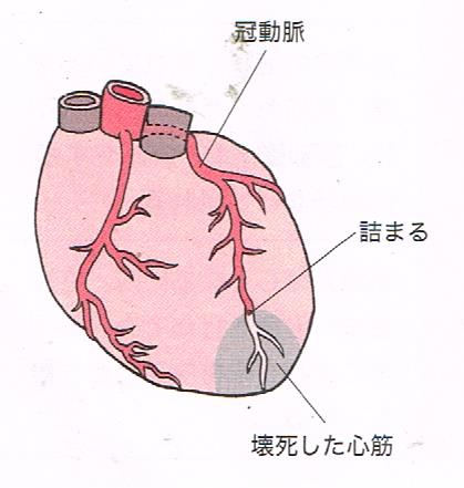 心筋梗塞