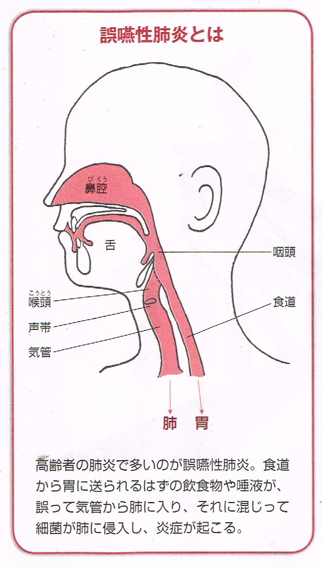 誤嚥とは