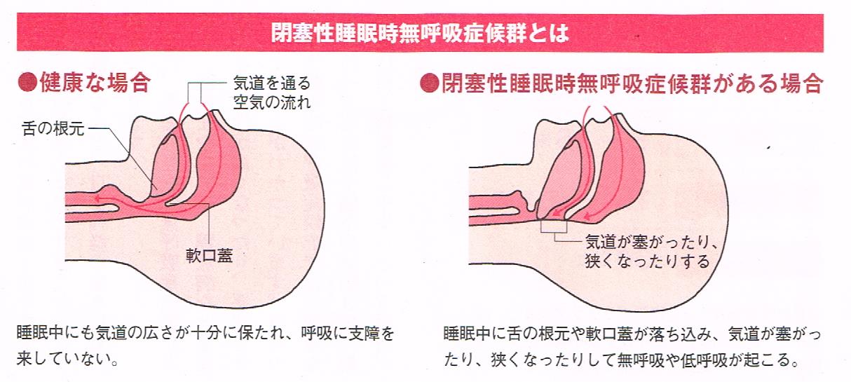 閉塞性睡眠時無呼吸症候群