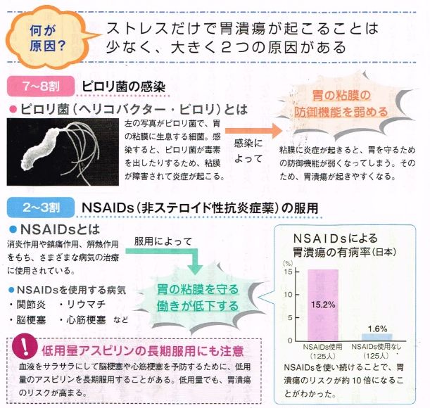 胃潰瘍の症状