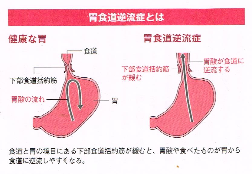 胃食道逆流症の原因