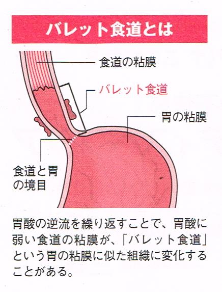 バレット食道