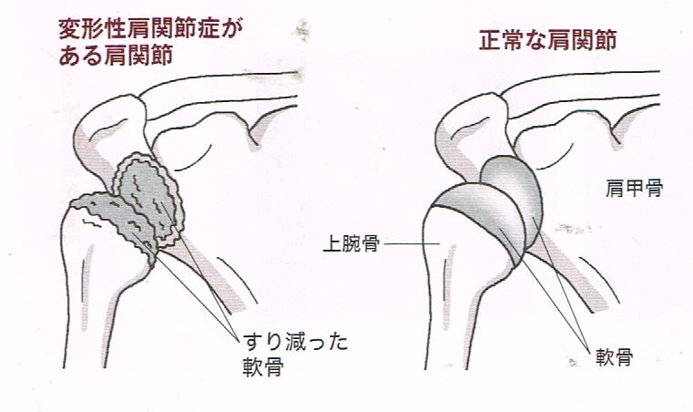 変形性肩関節症