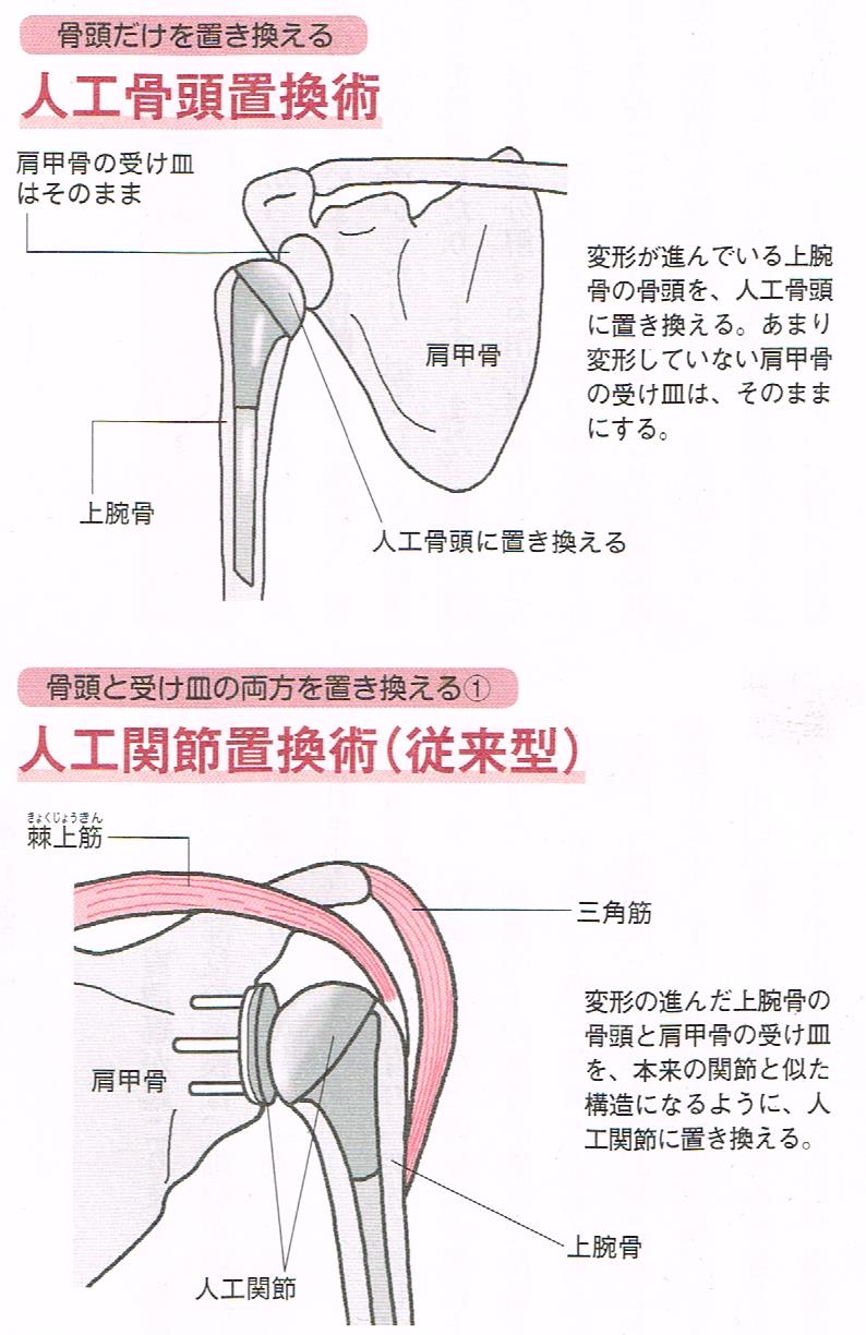 人工骨頭置換術