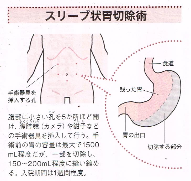 スリーブ状胃切開術