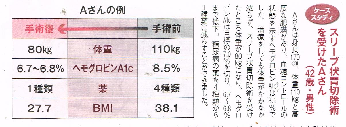 スリーブ状胃切開術の例