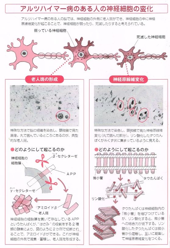 アルツハイマー型認知症のある人の神経細胞の変化