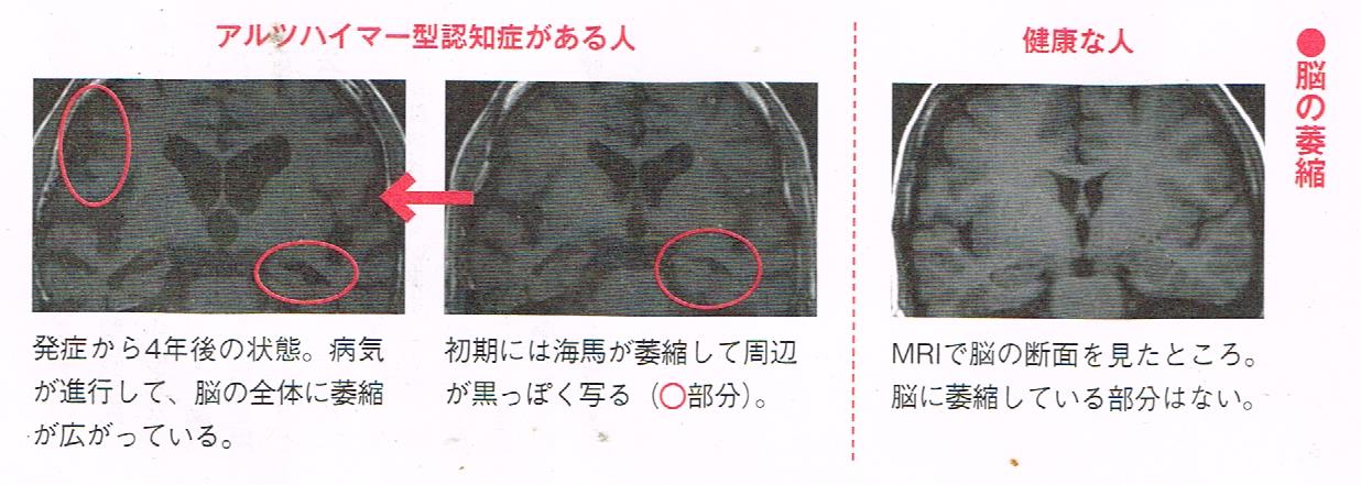 脳に起こる変化